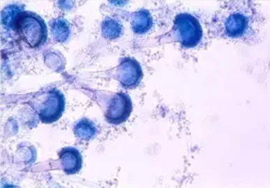 Europe Release Chronic Pulmonary Aspergillosis (CPA): Rationale and Clinical Guideline for Diagnosis
